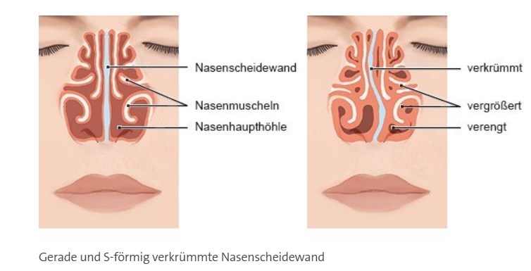 Abbild einer geraden und S-f&ouml;rmig verkr&uuml;mmten Nasenscheidewand
