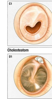 Trommelfellperforation Ursachen Behandlung Prof Dr Ernst