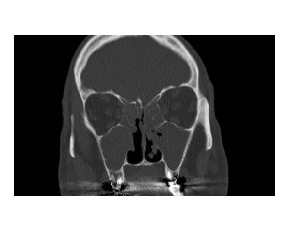 NNH-CT-Bild einer chronischen Sinusitis mit subtotaler Verschattung aller Nasenebenhöhlen